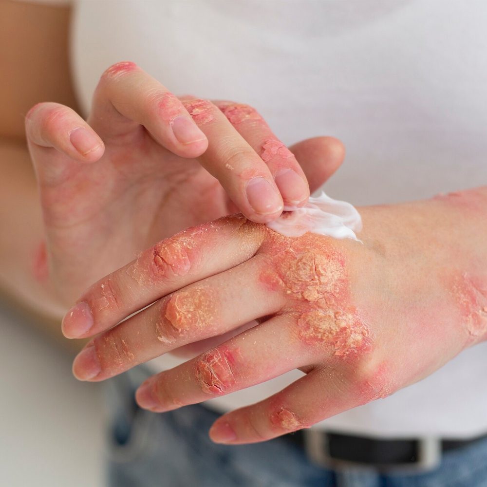 Eczema2